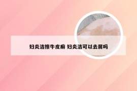 妇炎洁擦牛皮癣 妇炎洁可以去屑吗