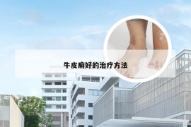 牛皮癣好的治疗方法
