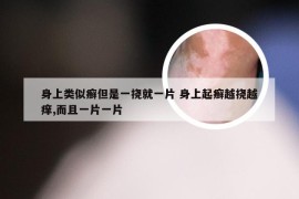 身上类似癣但是一挠就一片 身上起癣越挠越痒,而且一片一片