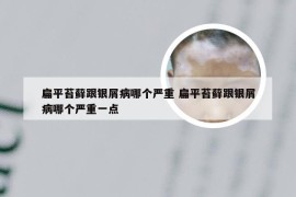 扁平苔藓跟银屑病哪个严重 扁平苔藓跟银屑病哪个严重一点