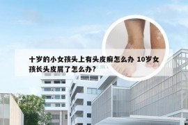 十岁的小女孩头上有头皮癣怎么办 10岁女孩长头皮屑了怎么办?
