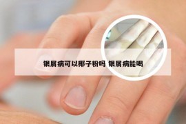 银屑病可以椰子粉吗 银屑病能喝