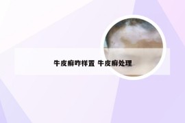 牛皮癣咋样置 牛皮癣处理