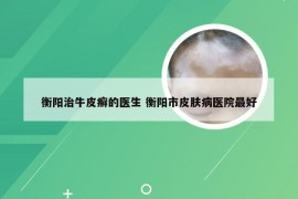衡阳治牛皮癣的医生 衡阳市皮肤病医院最好