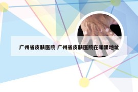 广州省皮肤医院 广州省皮肤医院在哪里地址