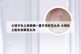 小孩子头上皮肤病一直不见好怎么办 小孩头上起头皮癣怎么办