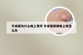 牛皮癣为什么晚上发作 牛皮银屑癣晚上痒怎么办