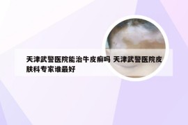 天津武警医院能治牛皮癣吗 天津武警医院皮肤科专家谁最好