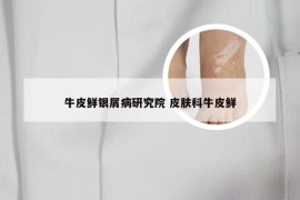 牛皮鲜银屑病研究院 皮肤科牛皮鲜