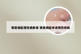银屑病能慢性病参保 银屑病能申请慢性救助