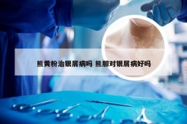 熊黄粉治银屑病吗 熊胆对银屑病好吗