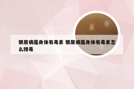 银屑病是身体有毒素 银屑病是身体有毒素怎么排毒