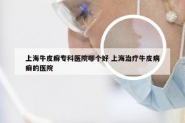上海牛皮癣专科医院哪个好 上海治疗牛皮病癣的医院