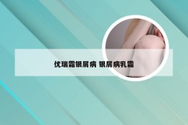 优瑞霜银屑病 银屑病乳霜