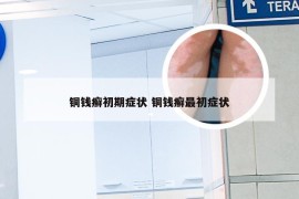 铜钱癣初期症状 铜钱癣最初症状