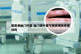 银屑病幽门杆菌 幽门螺杆菌与银屑病关系密切吗