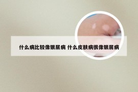什么病比较像银屑病 什么皮肤病很像银屑病