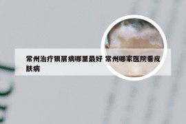 常州治疗银屑病哪里最好 常州哪家医院看皮肤病