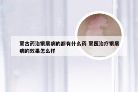蒙古药治银屑病的都有什么药 蒙医治疗银屑病的效果怎么样