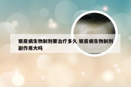 银屑病生物制剂要治疗多久 银屑病生物制剂副作用大吗