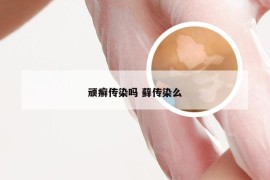 顽癣传染吗 藓传染么