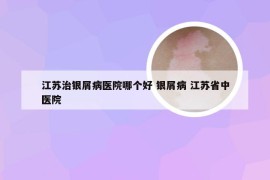 江苏治银屑病医院哪个好 银屑病 江苏省中医院