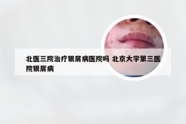 北医三院治疗银屑病医院吗 北京大学第三医院银屑病