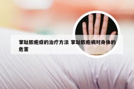 掌趾脓疱症的治疗方法 掌趾脓疱病对身体的危害