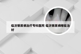 临沂银屑病治疗专科医院 临沂银屑病哪能治好