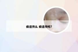 癣遗传么 癣遗传吗?