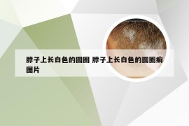 脖子上长白色的圆圈 脖子上长白色的圆圈癣图片