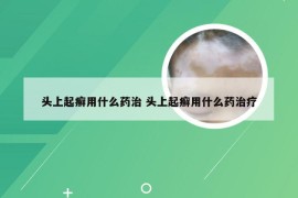 头上起癣用什么药治 头上起癣用什么药治疗