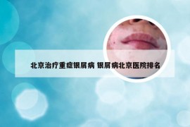 北京治疗重症银屑病 银屑病北京医院排名