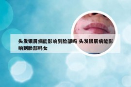 头发银屑病能影响到脸部吗 头发银屑病能影响到脸部吗女