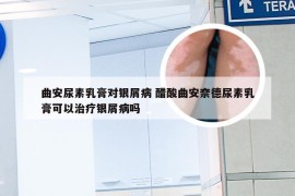 曲安尿素乳膏对银屑病 醋酸曲安奈德尿素乳膏可以治疗银屑病吗