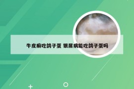 牛皮癣吃鸽子蛋 银屑病能吃鸽子蛋吗