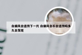 白癞风会遗传下一代 白癞风会不会遗传吗多久会发现
