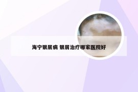 海宁银屑病 银屑治疗哪家医院好