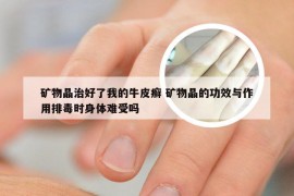 矿物晶治好了我的牛皮癣 矿物晶的功效与作用排毒时身体难受吗