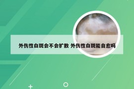 外伤性白斑会不会扩散 外伤性白斑能自愈吗