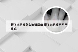 得了淋巴瘤怎么治银屑病 得了淋巴瘤严不严重吗