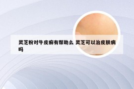 灵芝粉对牛皮癣有帮助么 灵芝可以治皮肤病吗