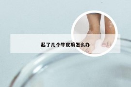 起了几个牛皮癣怎么办