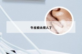牛皮癣太烦人了