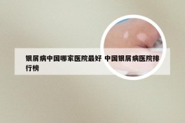 银屑病中国哪家医院最好 中国银屑病医院排行榜