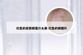 红色的皮肤癣是什么癣 红色的癣图片