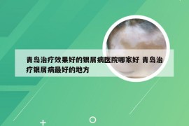 青岛治疗效果好的银屑病医院哪家好 青岛治疗银屑病最好的地方