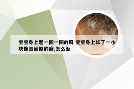 宝宝身上起一圈一圈的癣 宝宝身上长了一小块像圆圈似的癣,怎么治