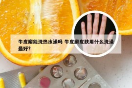 牛皮廨能洗热水澡吗 牛皮廨皮肤用什么洗澡最好?