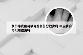 关节牛皮癣可以用醋氯芬分散片吗 牛皮肤癣可以用醋洗吗